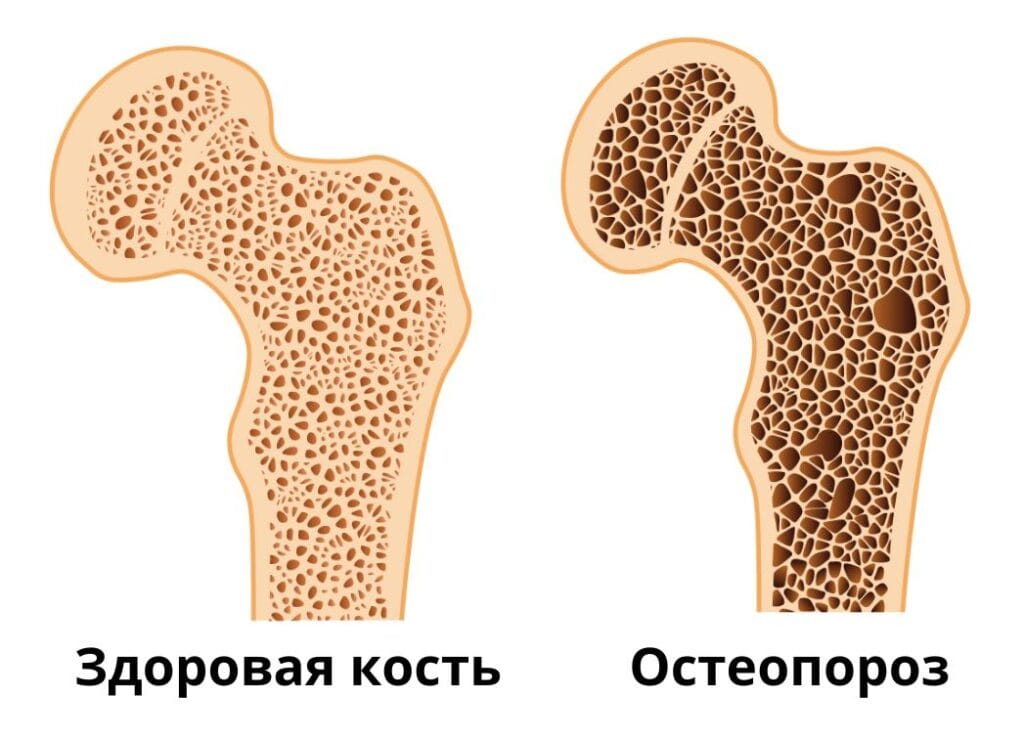 остеопороз